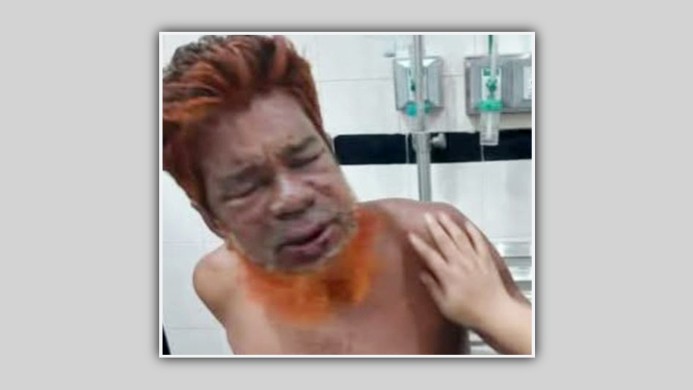 মতলব উত্তরে ভিমরুলের কামড়ে ১জনের মৃত্যু, আইসিইউতে ২জন