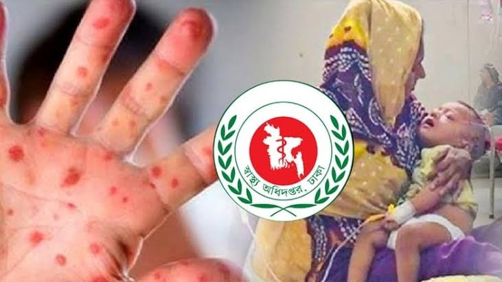 ২৪ ঘণ্টায় হাম ও উপসর্গে আরও ৪ জনের মৃত্যু, আক্রান্ত ৭৭৬