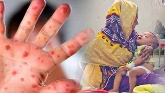 হামের উপসর্গে আরও ৩ মৃত্যু, হাসপাতালে ১,২২৮