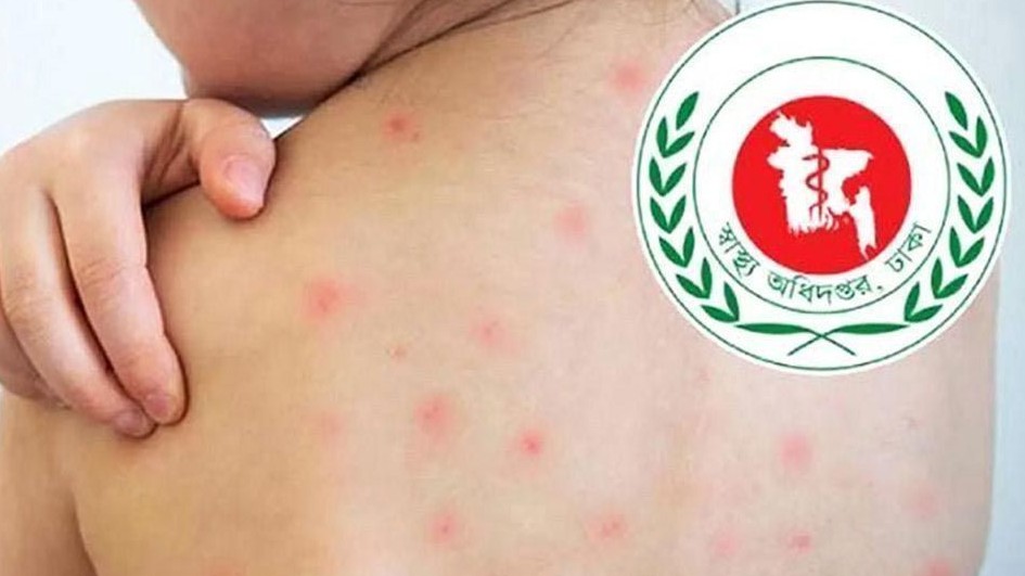 হামের উপসর্গে ঝরল আরও ৪ প্রাণ, মৃতের সংখ্যা ৯৬৭