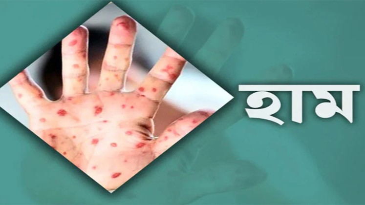 হামের উপসর্গে একদিনে ৮ মৃত্যু, সবাই ঢাকার